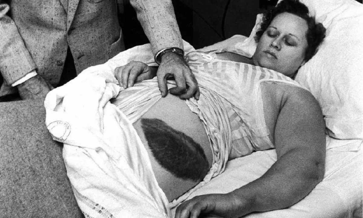 Der einzige Mensch der Geschichte, der je von einem Meteoriten getroffen wurde